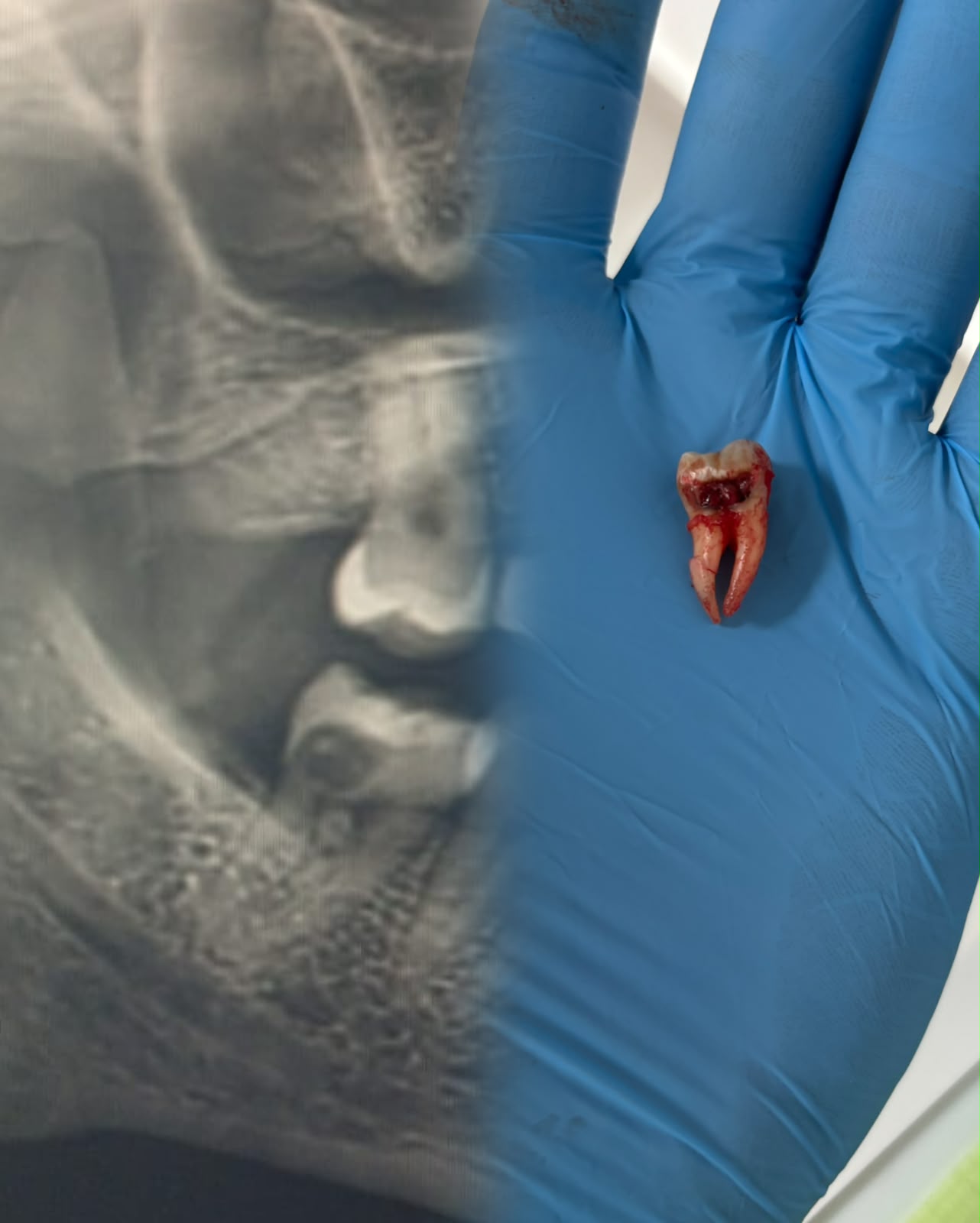 Chirurgie d'implant dentaire